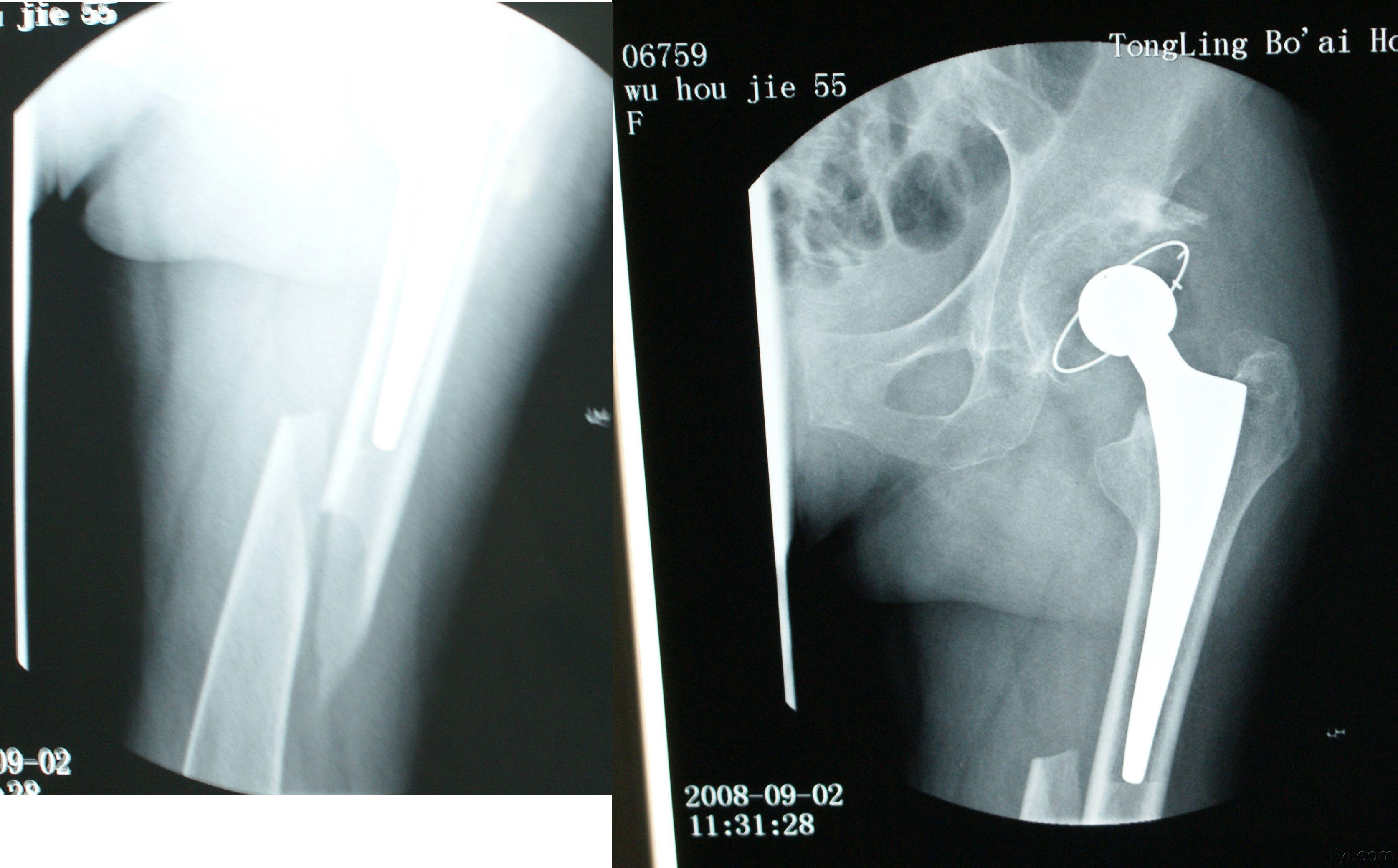 双髋关节置换术后半年股骨干骨折