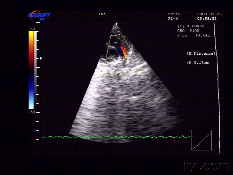 动脉导管未闭超声表现图片