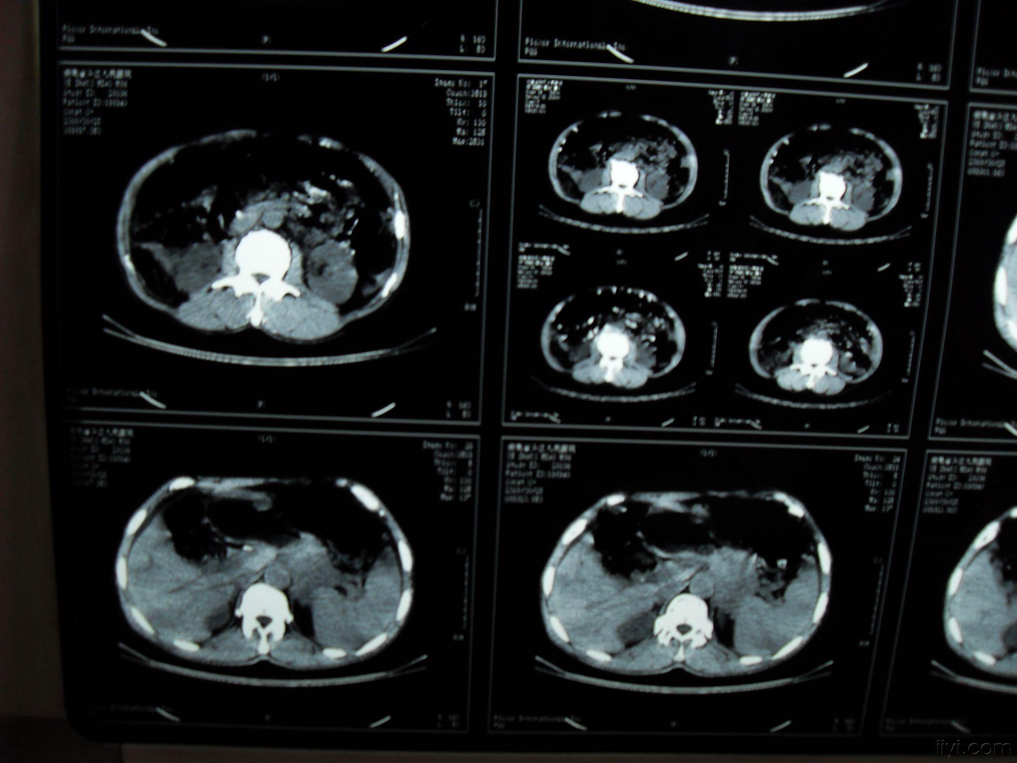 胃癌术后2年复查ct