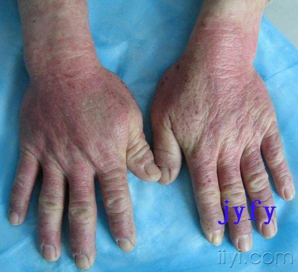 国庆特辑光线性皮肤病