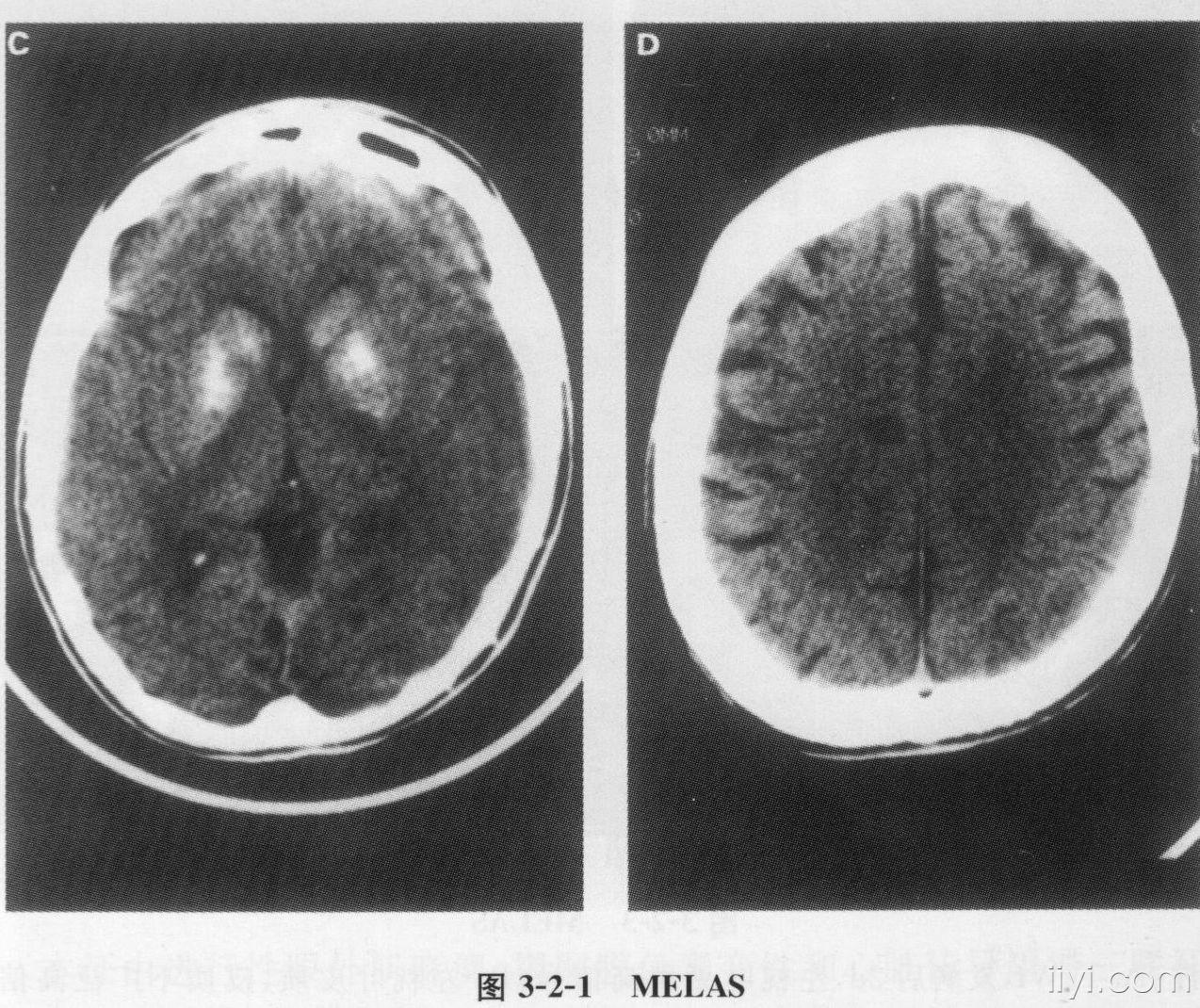 线粒体肌性脑病 医学影像学讨论版 爱爱医医学论坛