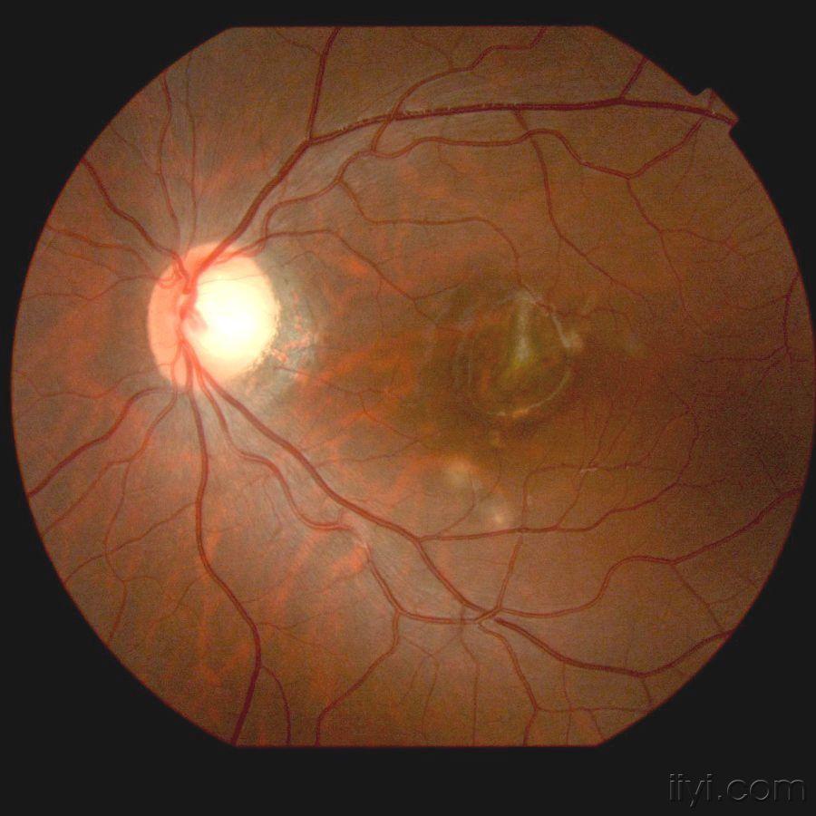 眼底病病例讨论