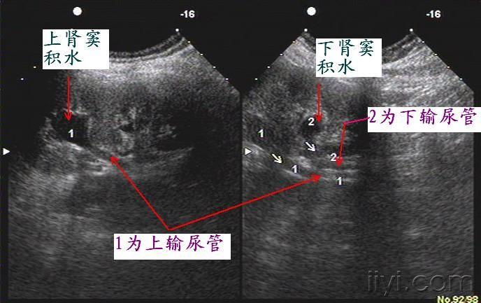 彩超重复肾声像图片图片