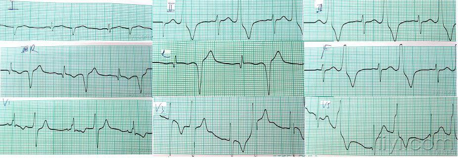 室早二联律心电图表现图片