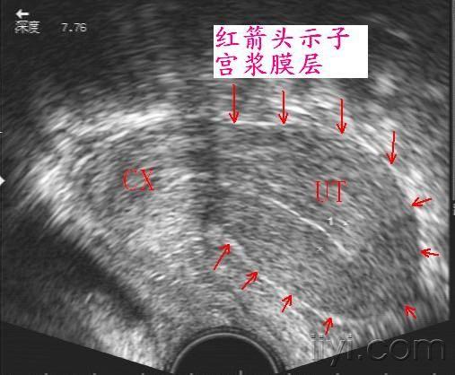 正常子宫和卵巢图片集