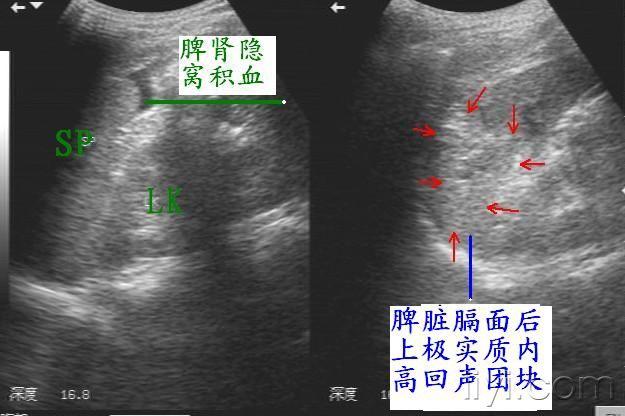 脾破裂超声图片