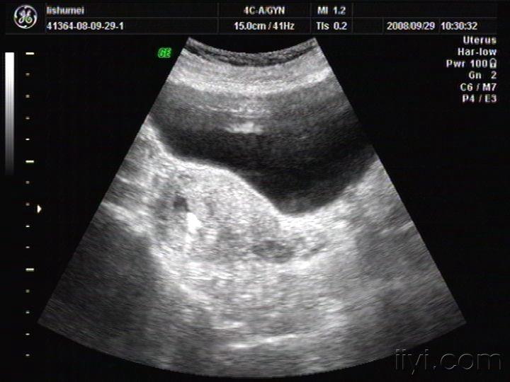 假孕囊及节育环回声