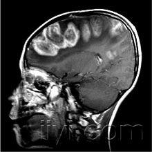 儿童病毒性脑炎的MR诊断和鉴别诊断