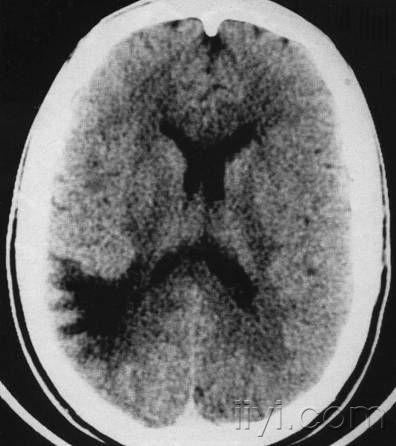 儿童病毒性脑炎的MR诊断和鉴别诊断