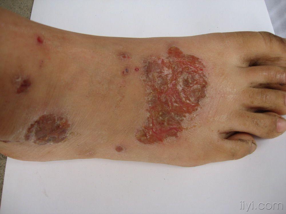 如何治这样的溃烂