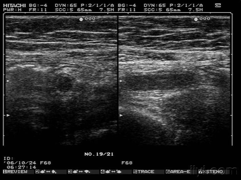 急性化脓性阑尾炎数例