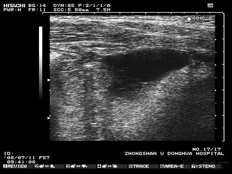 右髂窝少量积液