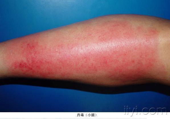 清晰丹毒让你的诊断不再犹豫