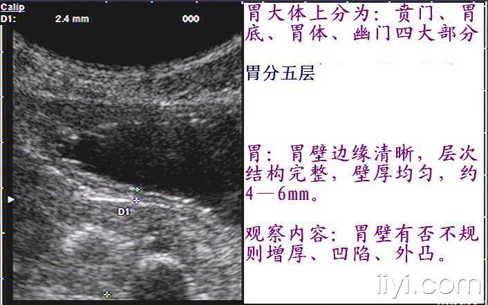 正常胃的超声图像图片