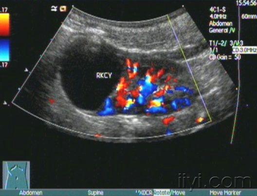 贴图小儿右肾囊肿声像图