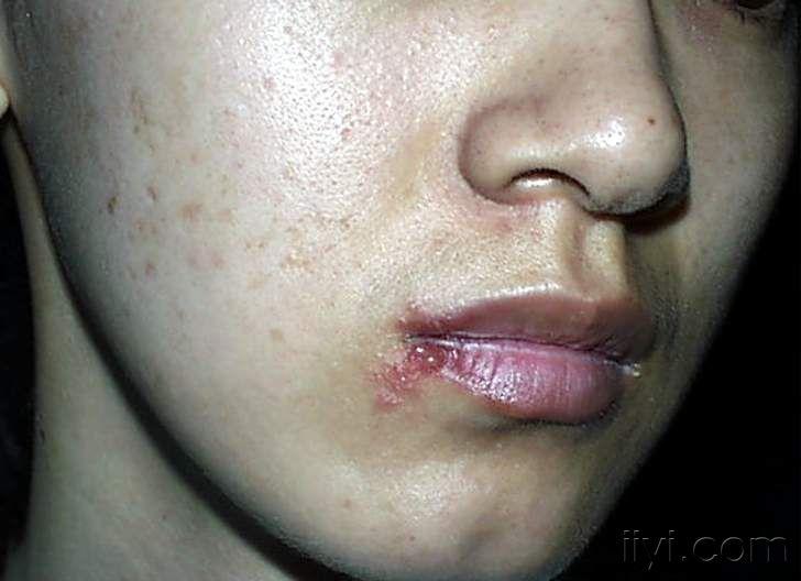 唇部疱疹初期图片
