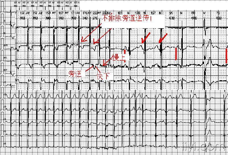室上速1例,請分析 - 心電圖腦電圖專業討論版 - 愛愛醫醫學論壇