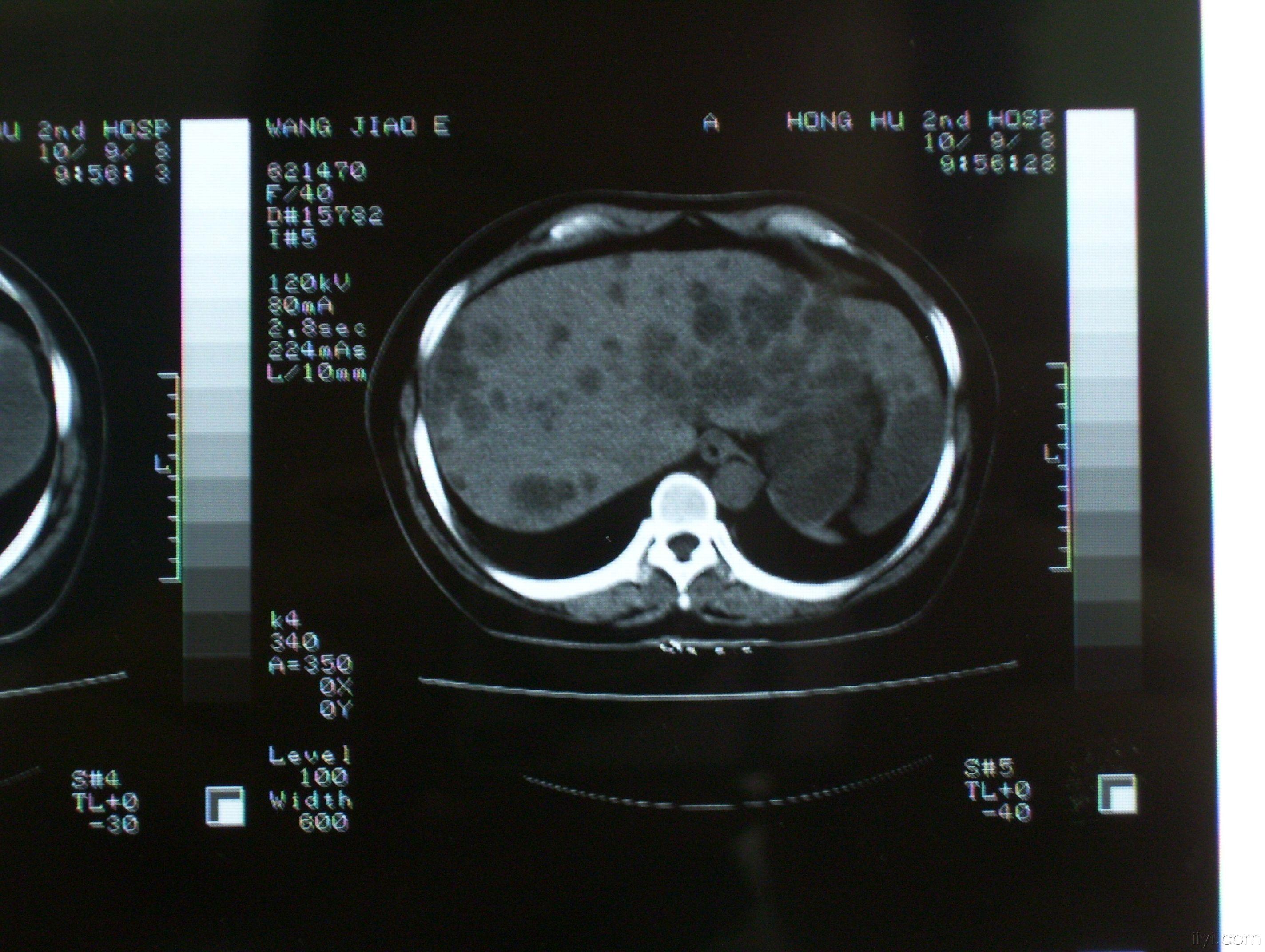 多囊肝图片清晰版图片