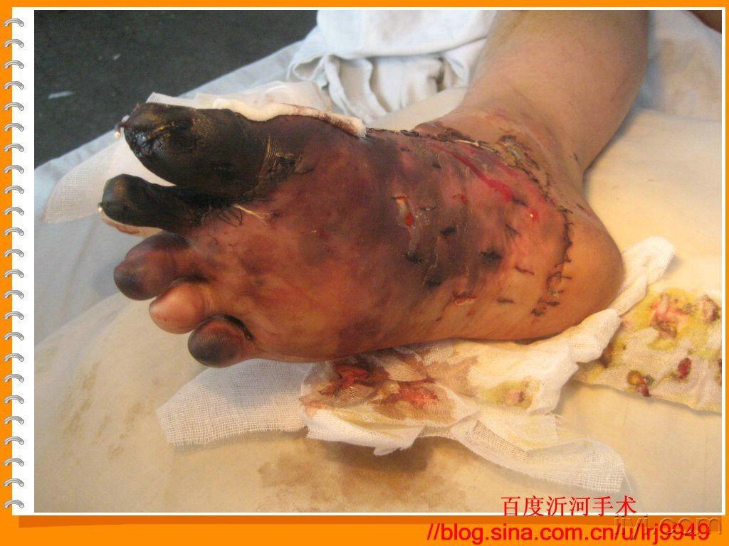 一例足挤压伤的转归