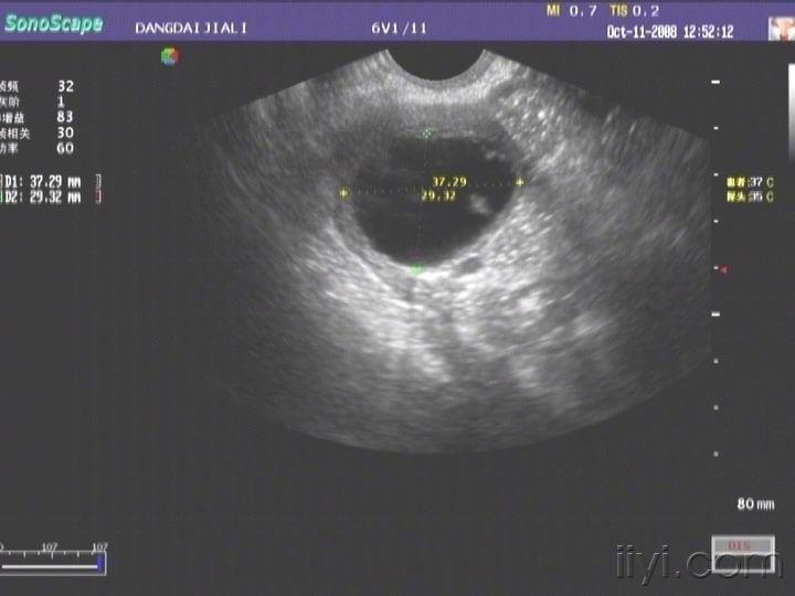 黄体囊肿超声声像图图片