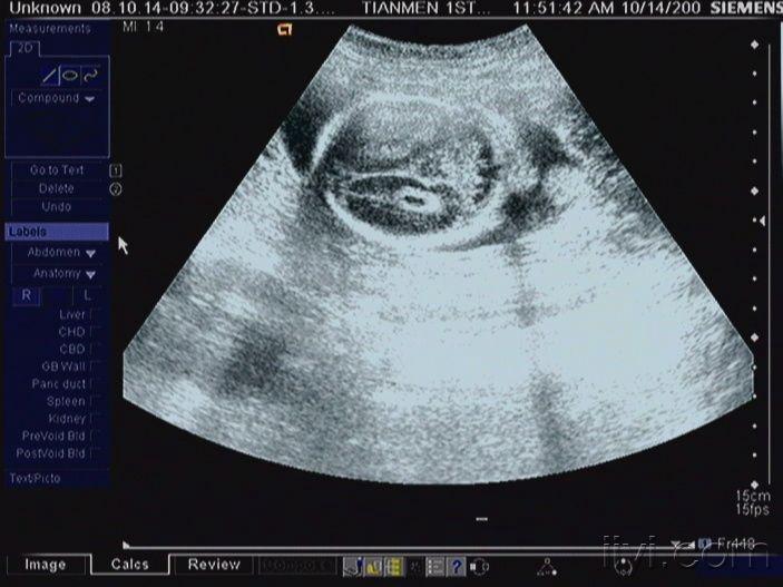 胎儿脉络丛囊肿图片图片