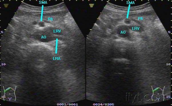 胡桃夹综合征超声图片