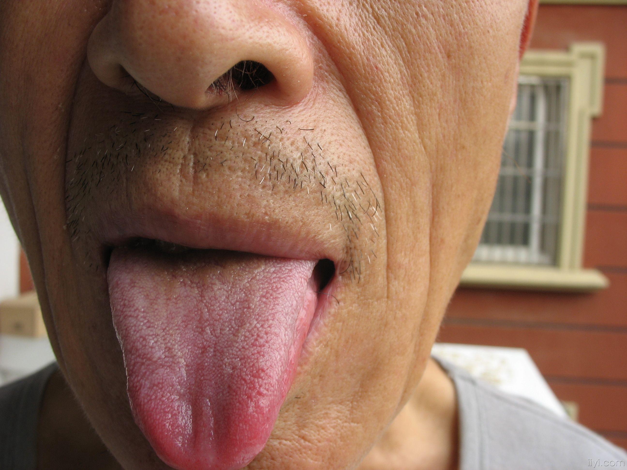治疗后舌苔的动态变化