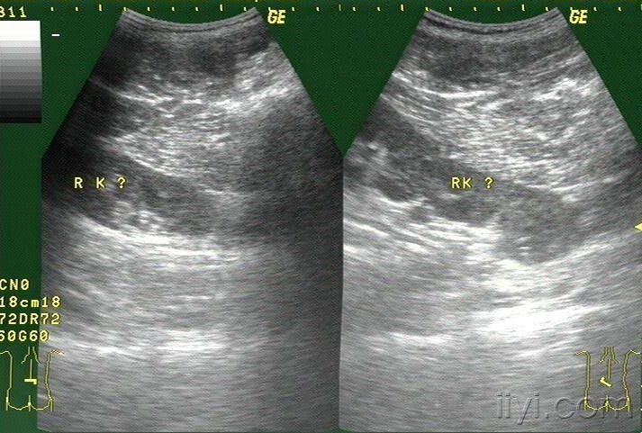 融合肾超声图片图片