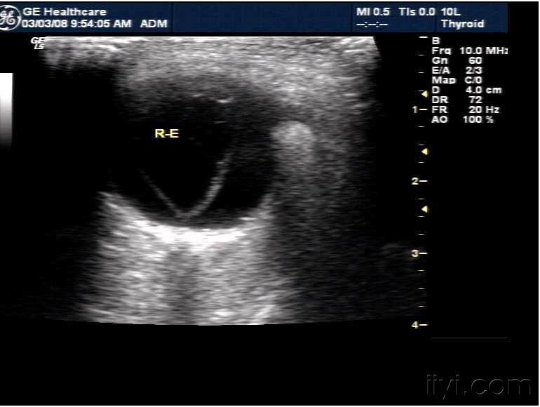右眼完全性视网膜脱离. - 超声医学讨论版 - 爱爱医医学论坛