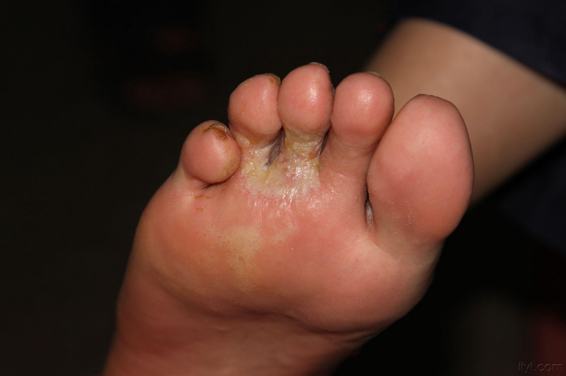 脚汗疱疹初期图片图片