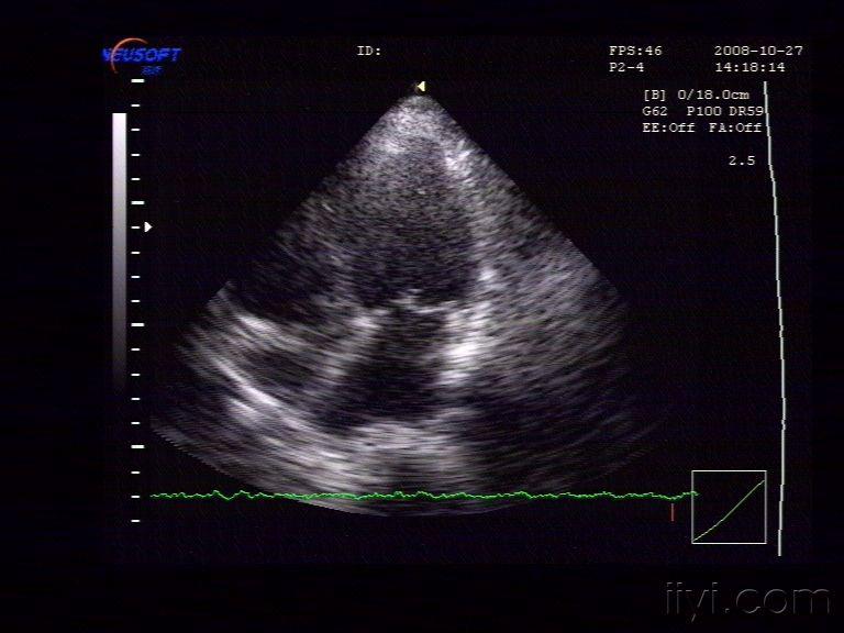 二尖瓣前后叶超声图片