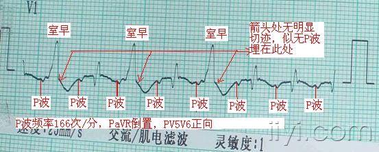 心电图走纸速度和电压图片