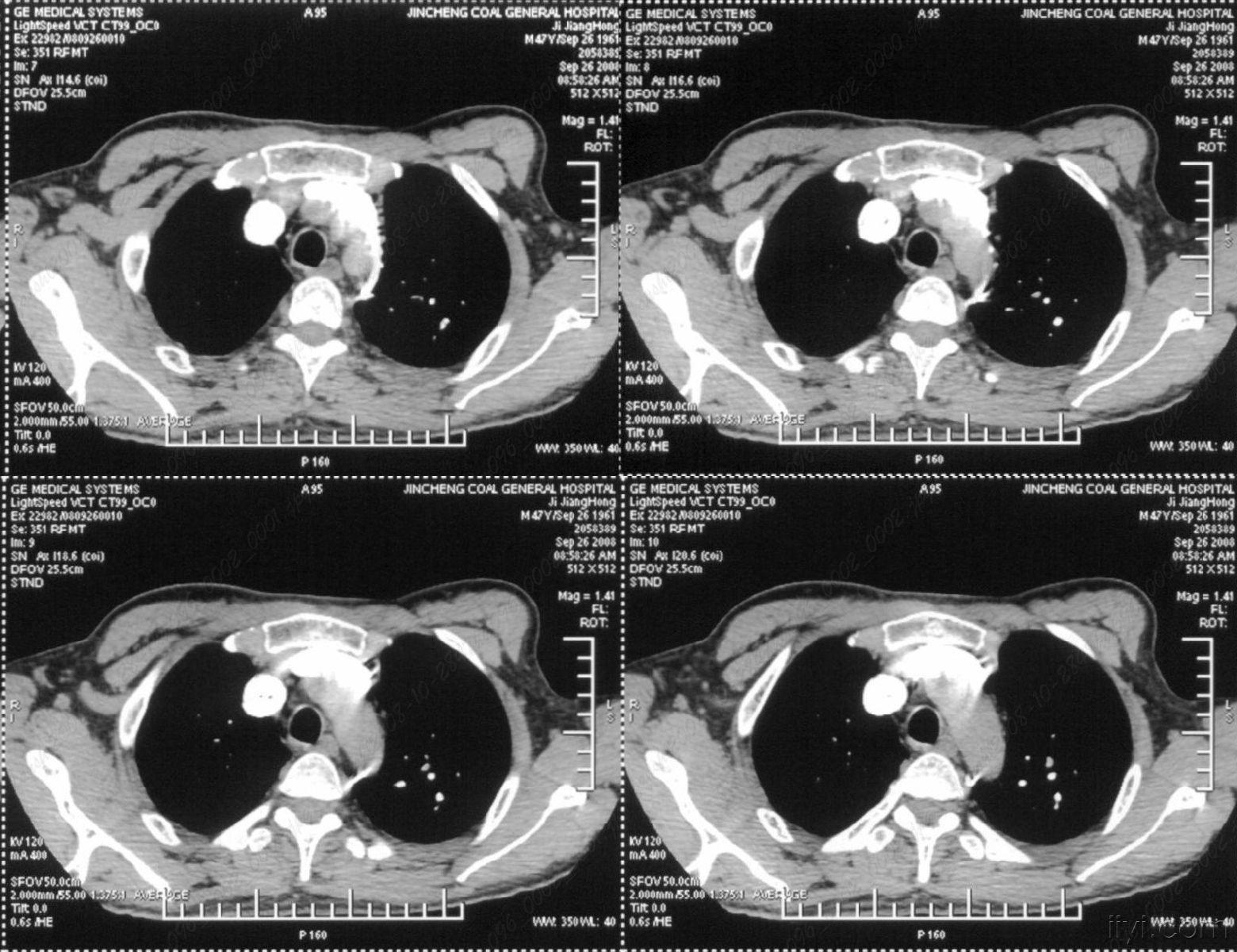 胸部不适一年,ct检查发现右胸膜下结节.[两周后公布结果]