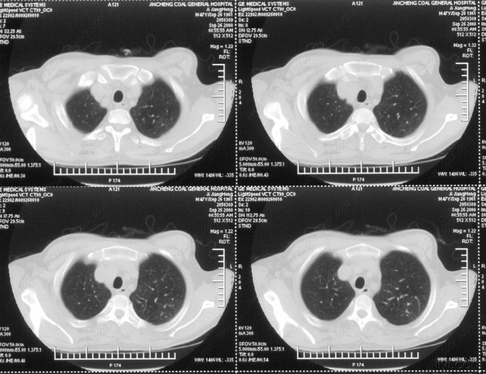 胸部不适一年,ct检查发现右胸膜下结节.[两周后公布结果]