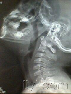 腺样体肥大一例及说明