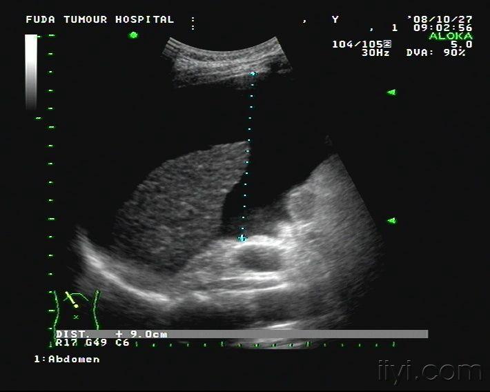 腹水的超声测量图解图片