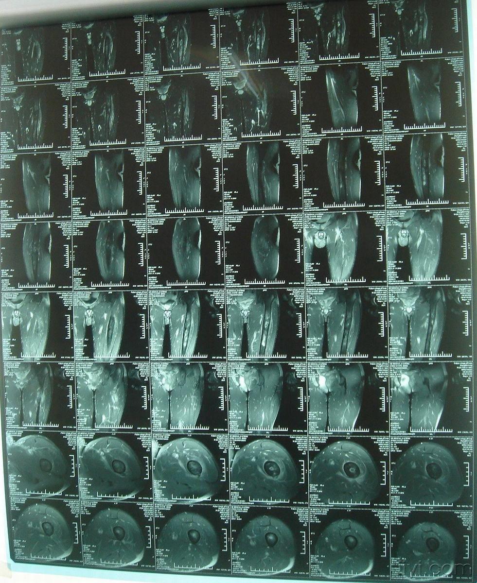 【病例讨论】左股骨慢性骨髓炎