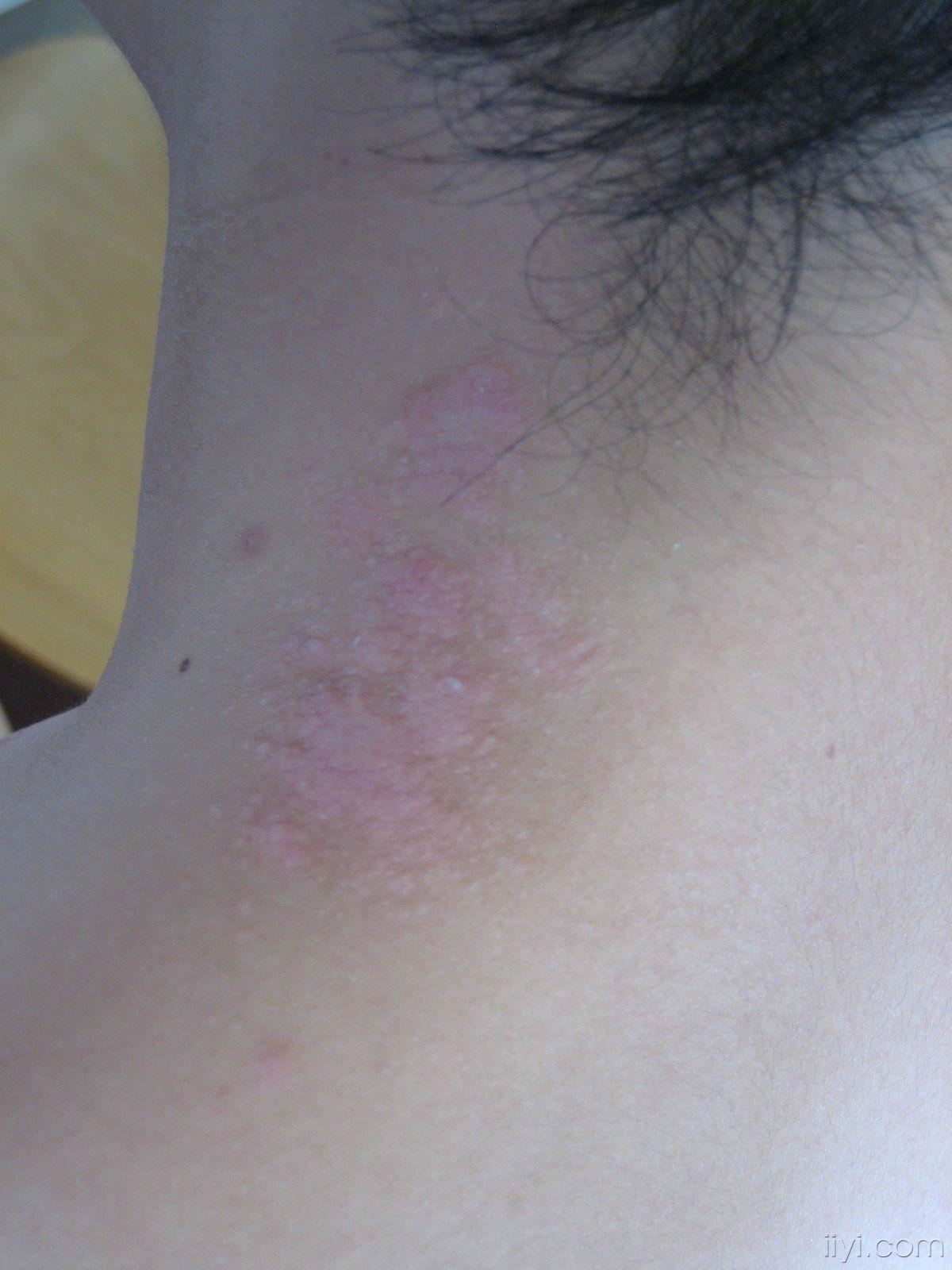 请大家帮我确认病情和治疗方案怀疑神经性皮炎