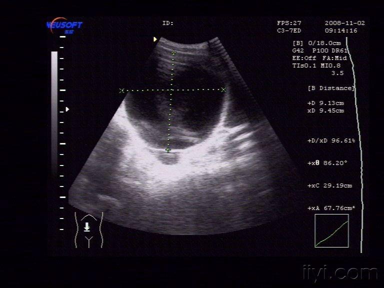 卵巢冠囊肿超声图片图片