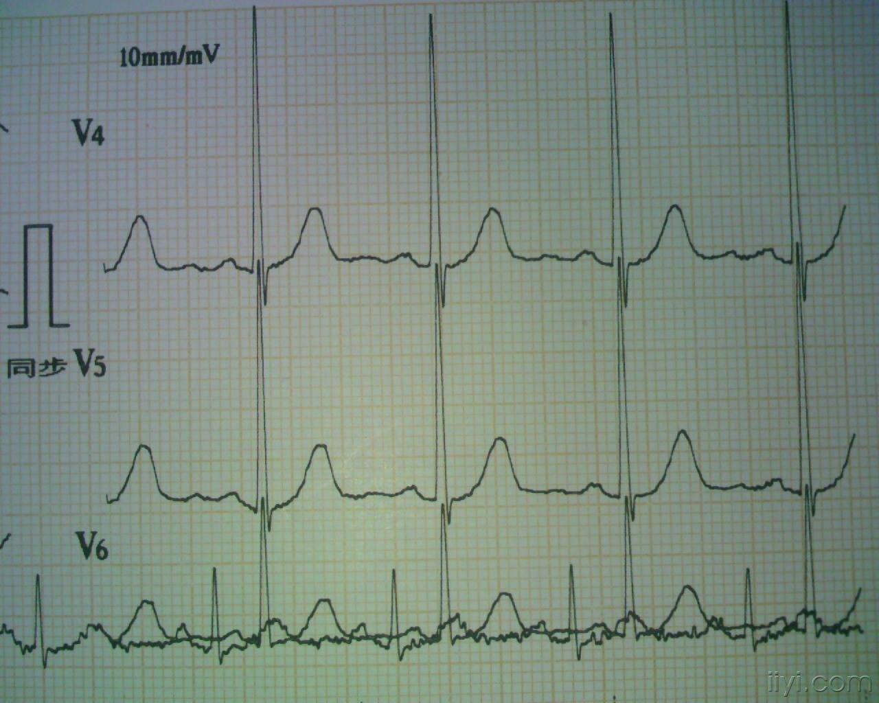 右室心电图图片