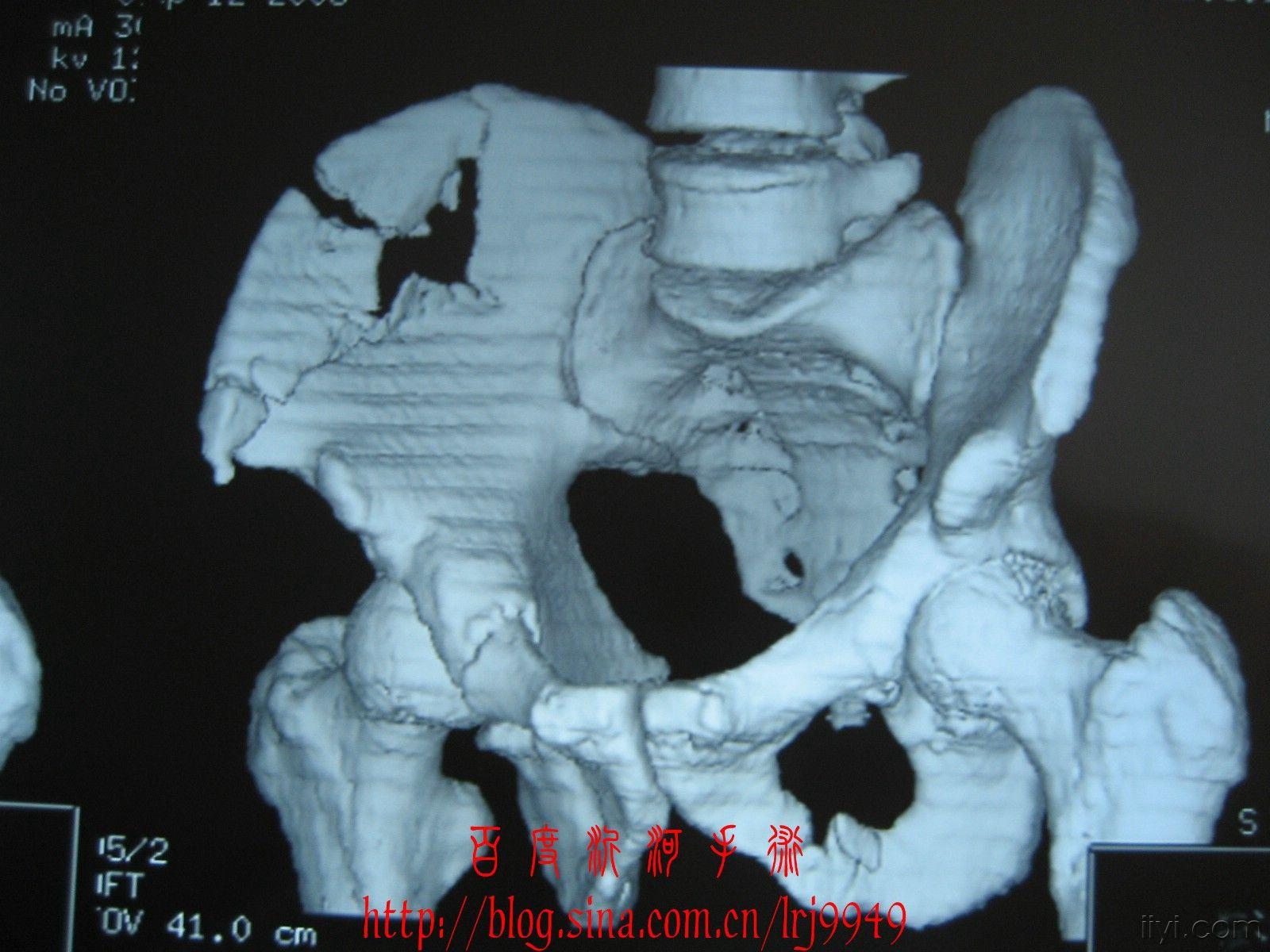 这个骨盆骨折如何做