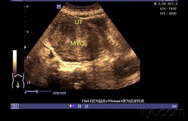 术中考虑子宫肉瘤. - 超声医学讨论版 - 爱爱医医学论坛