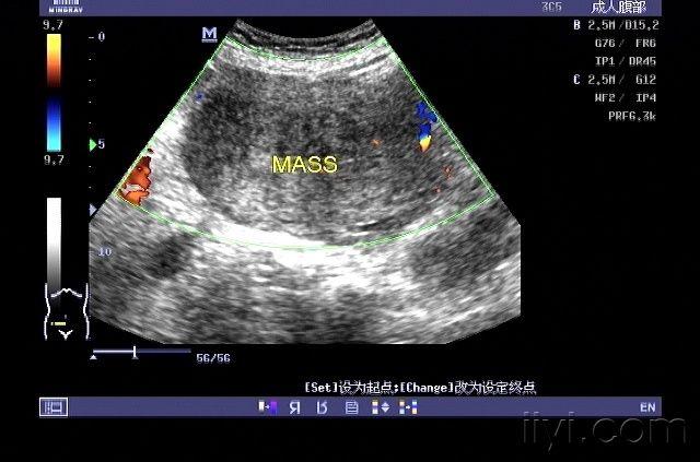 术中考虑子宫肉瘤. - 超声医学讨论版 - 爱爱医医学论坛