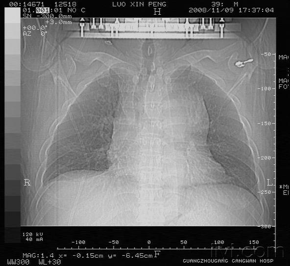胸痛查因,平片示纵隔明显增宽