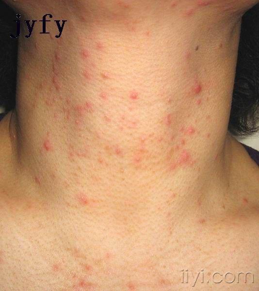 美图鉴赏12——蠕形螨皮炎