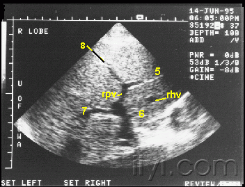肝脏五叶八段超声图谱图片
