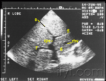 肝叶分段超声图谱图片