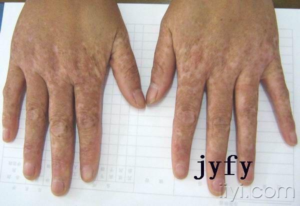 美图鉴赏21遗传性对称性色素异常症