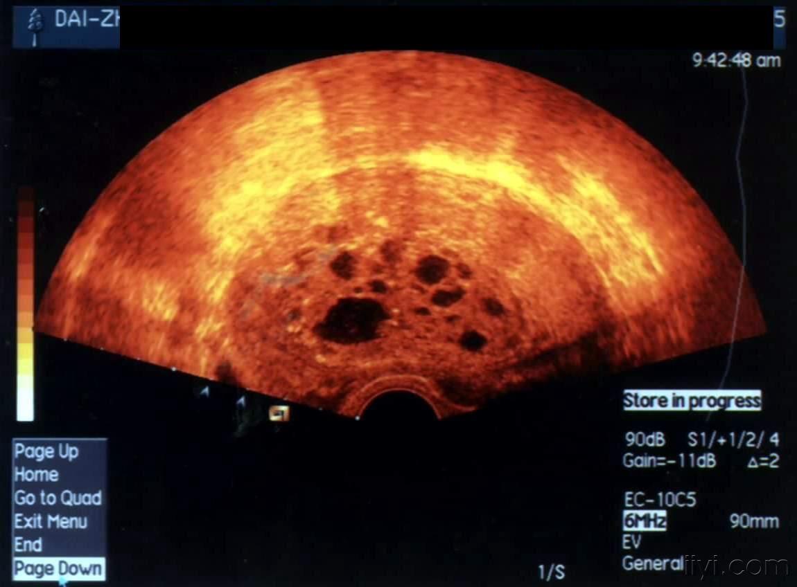 【讨论】葡萄胎超声诊断