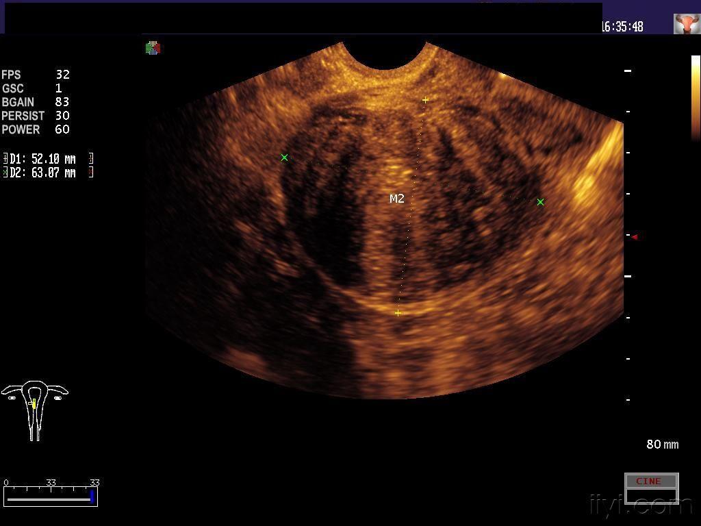 误诊提醒(一):宫内胎物残留 - 超声医学讨论版 - 爱爱医医学论坛